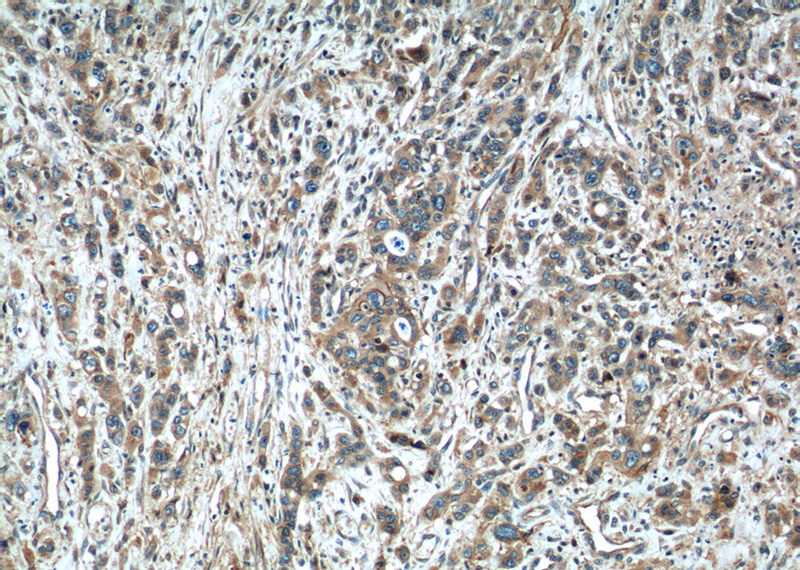 Immunohistochemistry of paraffin-embedded human stomach cancer tissue slide using Catalog No:107770(ADAMTS12 Antibody) at dilution of 1:50 (under 10x lens)