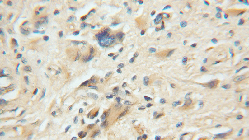 Immunohistochemical of paraffin-embedded human gliomas using Catalog No:114154(PPP5C antibody) at dilution of 1:100 (under 10x lens)