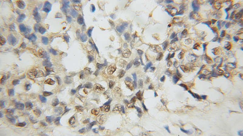 Immunohistochemical of paraffin-embedded human breast cancer using Catalog No:114514(RAD23B antibody) at dilution of 1:50 (under 10x lens)