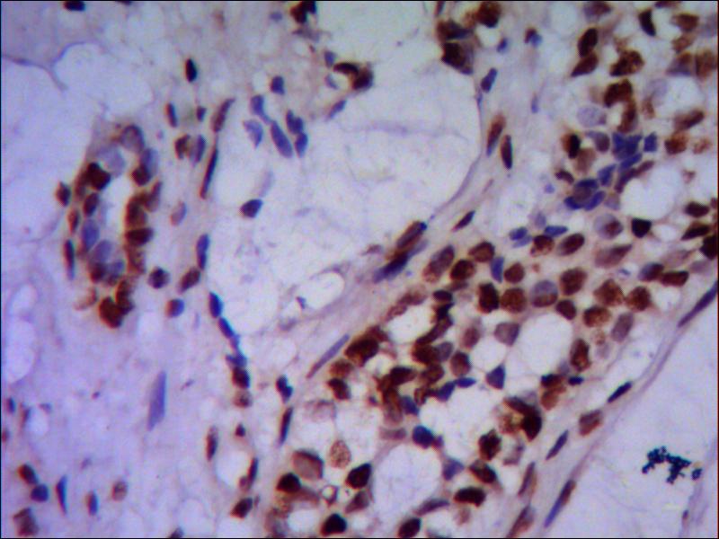Immunohistochemistry stain of paraffin-embedded human breast cancer using PRMT6 mouse mAb (1:200).