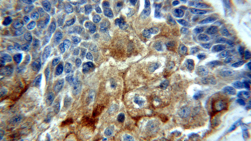 Immunohistochemical of paraffin-embedded human oesophagus cancer using Catalog No:112230(LIMS1 antibody) at dilution of 1:50 (under 40x lens)
