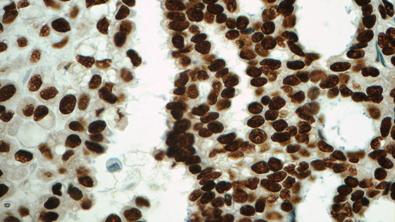 Immunohistochemistry of paraffin-embedded human ovary tumor tissue slide using Catalog No:110220(EGR1 Antibody) at dilution of 1:50 (under 40x lens)