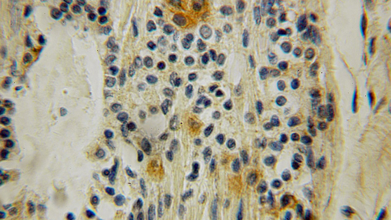 Immunohistochemical of paraffin-embedded human breast cancer using Catalog No:115182(SH2D3C antibody) at dilution of 1:100 (under 10x lens)
