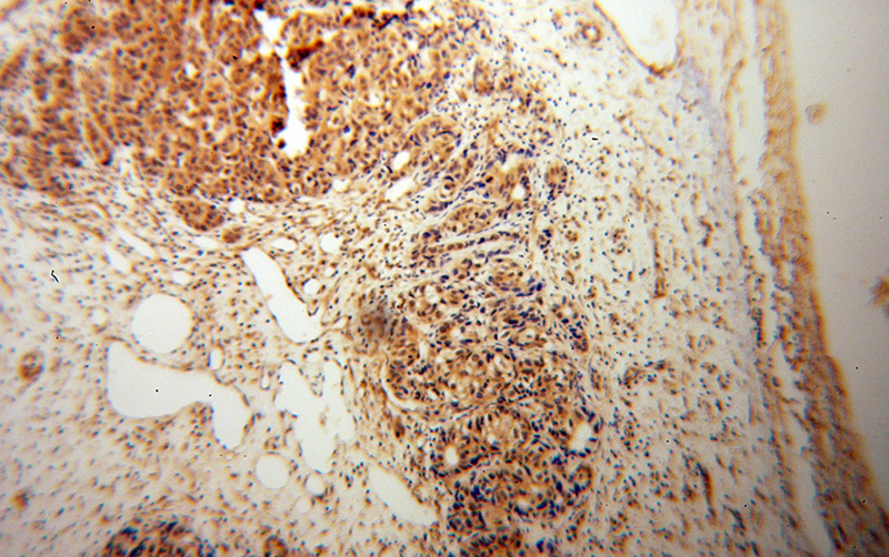 Immunohistochemical of paraffin-embedded human liver cancer using Catalog No:109443(COMMD1 antibody) at dilution of 1:50 (under 10x lens)