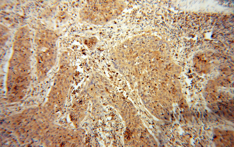 Immunohistochemical of paraffin-embedded human cervical cancer using Catalog No:110868(GART antibody) at dilution of 1:100 (under 10x lens)