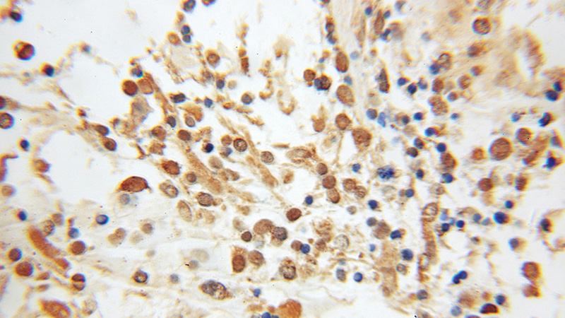 Immunohistochemical of paraffin-embedded human gliomas using Catalog No:114022(PMF1 antibody) at dilution of 1:50 (under 10x lens)