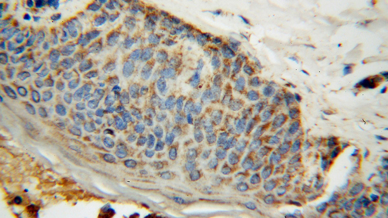Immunohistochemical of paraffin-embedded human skin cancer using Catalog No:113679(PDHB antibody) at dilution of 1:100 (under 40x lens)