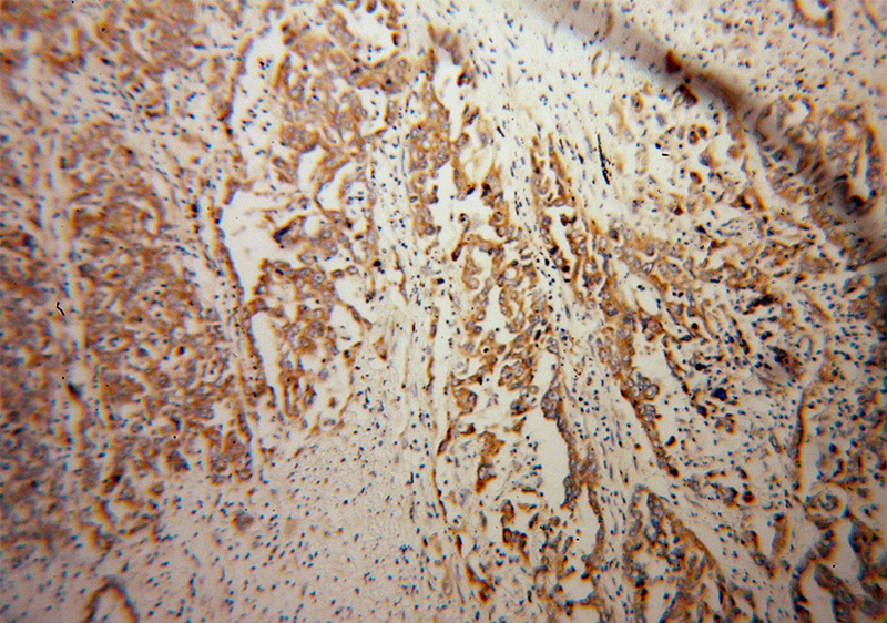 Immunohistochemical of paraffin-embedded human pancreas cancer using Catalog No:111965(KCNIP1 antibody) at dilution of 1:100 (under 10x lens)