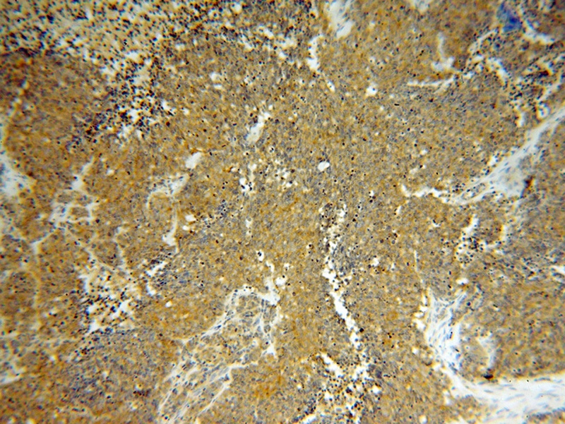 Immunohistochemical of paraffin-embedded human lung cancer using Catalog No:115810(STXBP2 antibody) at dilution of 1:100 (under 10x lens)