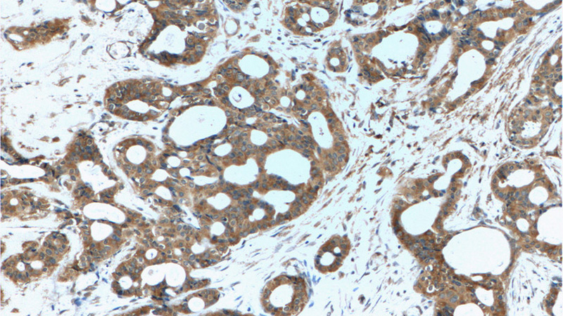 Immunohistochemistry of paraffin-embedded human breast cancer tissue slide using Catalog No:115862(TBC1D17 Antibody) at dilution of 1:50 (under 10x lens)