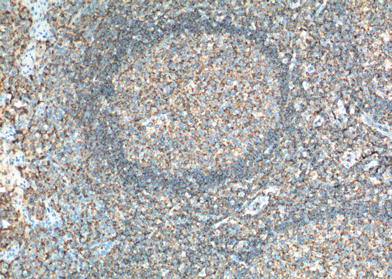 Immunohistochemistry of paraffin-embedded human tonsillitis tissue slide using Catalog No:107137(CD45 Antibody) at dilution of 1:300 (under 10x lens). heat mediated antigen retrieved with Tris-EDTA buffer(pH9).