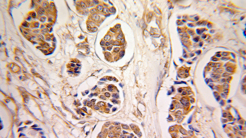 Immunohistochemical of paraffin-embedded human breast cancer using Catalog No:114026(PMM2 antibody) at dilution of 1:100 (under 25x lens)