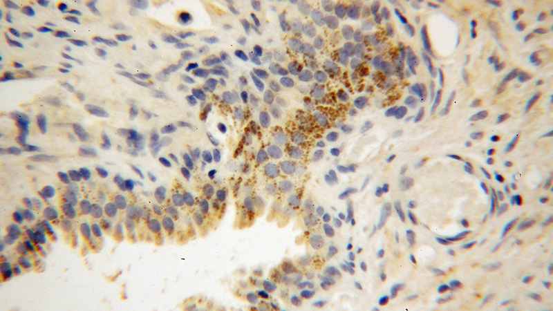 Immunohistochemical of paraffin-embedded human gliomas using Catalog No:112901(MKLN1 antibody) at dilution of 1:50 (under 40x lens)