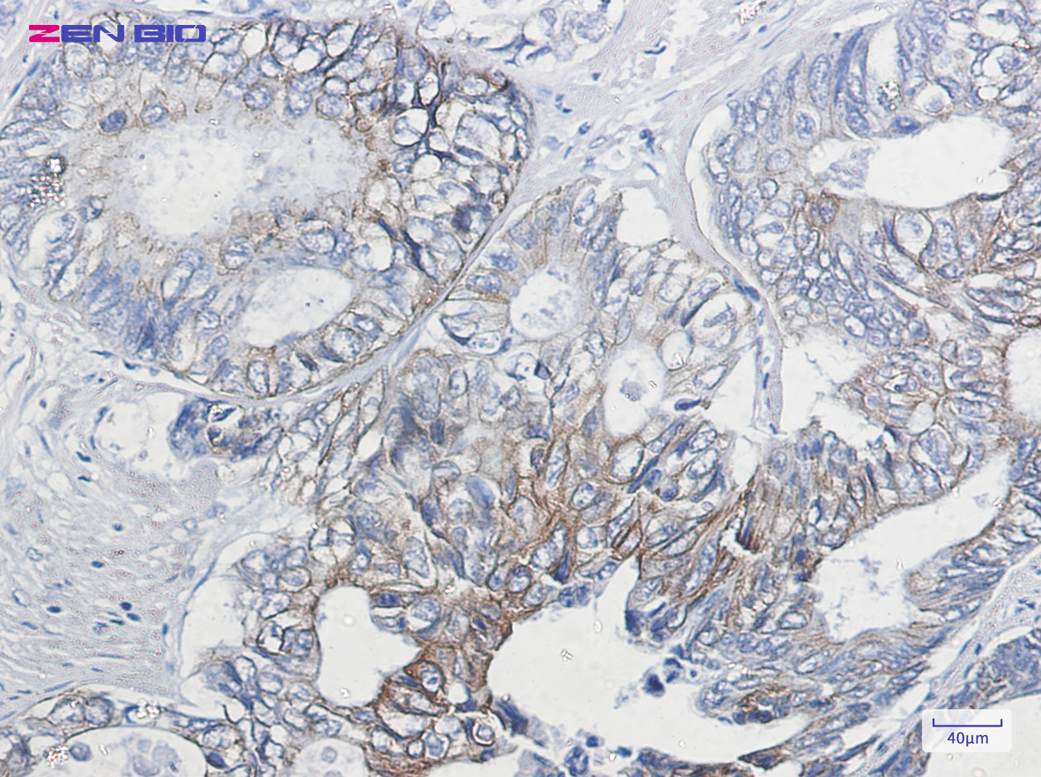 Immunohistochemistry of Cytokeratin 8 (Phospho-Ser23) in paraffin-embedded Human colon cancer tissue using Cytokeratin 8 (Phospho-Ser23) Rabbit pAb at dilution 1/20