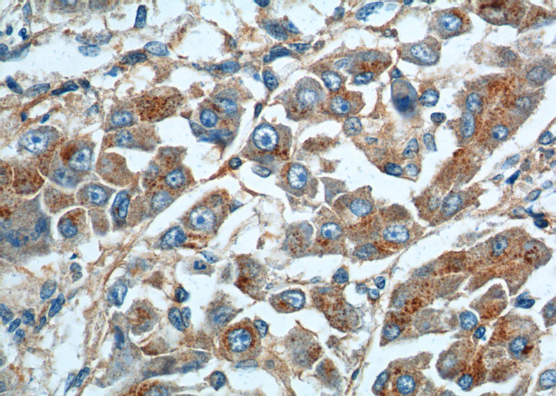 Immunohistochemistry of paraffin-embedded human liver cancer tissue slide using Catalog No:108055(ANGPTL1 Antibody) at dilution of 1:50 (under 40x lens).