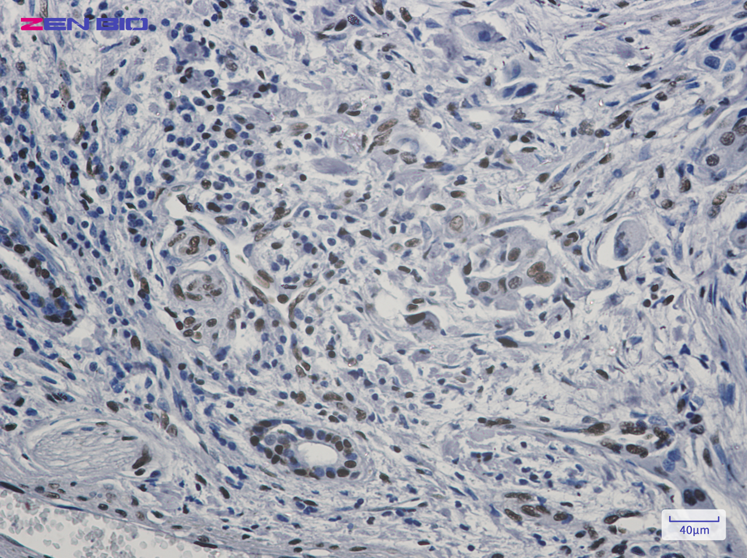 Immunohistochemistry of FAM98B in paraffin-embedded Human lung cancer tissue using FAM98B Rabbit pAb at dilution 1/20