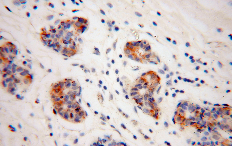 Immunohistochemical of paraffin-embedded human colon cancer using Catalog No:109452(GJB1 antibody) at dilution of 1:50 (under 40x lens)