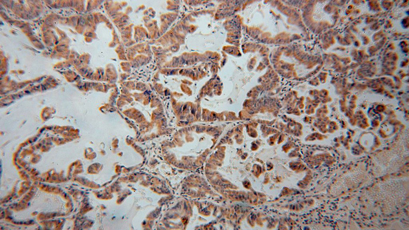 Immunohistochemical of paraffin-embedded human lung cancer using Catalog No:110605(FCRLB antibody) at dilution of 1:100 (under 10x lens)