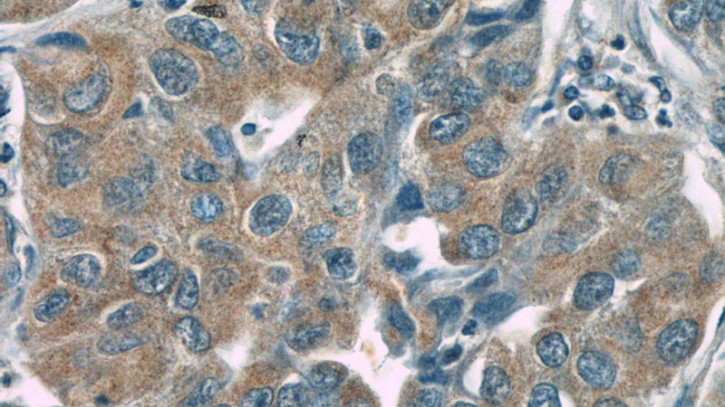 Immunohistochemistry of paraffin-embedded human lung cancer slide using Catalog No:108953(CC2D2A Antibody) at dilution of 1:50(under 40x lens)