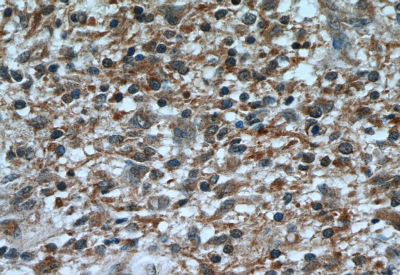 Immunohistochemical of paraffin-embedded human gliomas using Catalog No:113115(NES antibody) at dilution of 1:50 (under 40x lens)