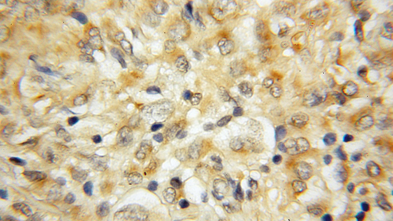 Immunohistochemical of paraffin-embedded human gliomas using Catalog No:114420(RAB22A antibody) at dilution of 1:50 (under 10x lens)