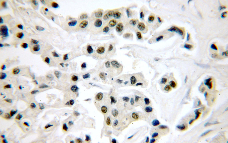 Immunohistochemical of paraffin-embedded human breast cancer using Catalog No:114362(PYGO2 antibody) at dilution of 1:50 (under 40x lens)