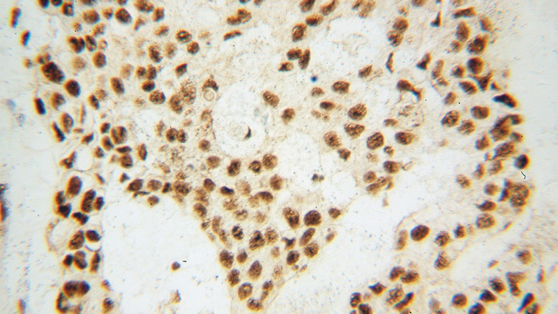 Immunohistochemical of paraffin-embedded human breast cancer using Catalog No:115465(SNRPG antibody) at dilution of 1:100 (under 40x lens)