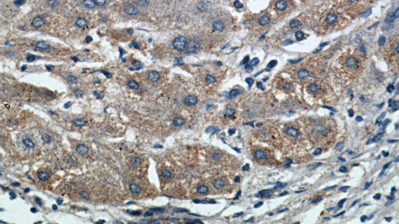 Immunohistochemical of paraffin-embedded human hepatocirrhosis using Catalog No:112729(MOGAT1 antibody) at dilution of 1:50 (under 40x lens)