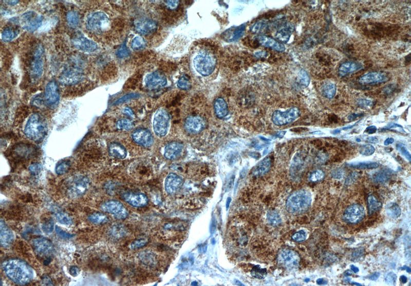 Immunohistochemistry of paraffin-embedded human lung cancer slide using Catalog No:116496(NPR2L,TUSC4 Antibody) at dilution of 1:50