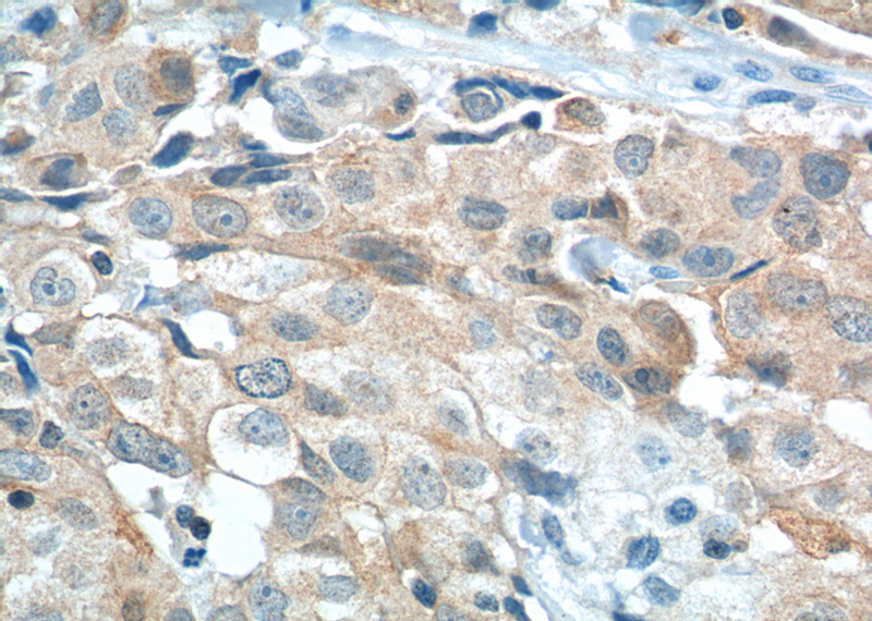 Immunohistochemistry of paraffin-embedded human lung cancer tissue slide using Catalog No:107611(STXBP2 Antibody) at dilution of 1:400 (under 40x lens). heat mediated antigen retrieved with Tris-EDTA buffer(pH9).