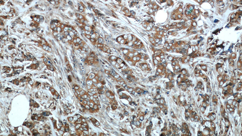 Immunohistochemical of paraffin-embedded human breast cancer using Catalog No:113023(NBR1 antibody) at dilution of 1:50 (under 10x lens)