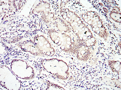 Immunohistochemical analysis of paraffin-embedded lung cancer tissues using SMAD4 mouse mAb with DAB staining.
