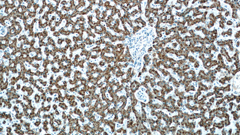 Immunohistochemistry of paraffin-embedded human liver slide using Catalog No:107840(AGXT Antibody) at dilution of 1:50