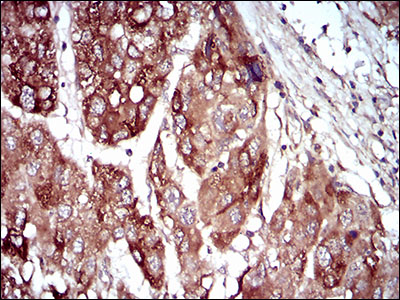 Immunohistochemical analysis of paraffin-embedded liver cancer tissues using MAP2K5 mouse mAb with DAB staining.