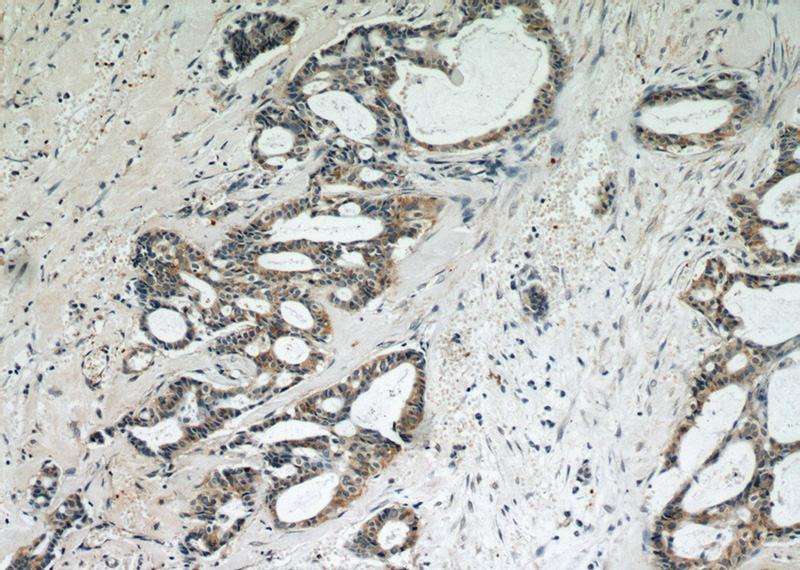 Immunohistochemical of paraffin-embedded human breast cancer using Catalog No:115290(SKP2 antibody) at dilution of 1:50 (under 10x lens)