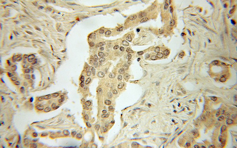 Immunohistochemical of paraffin-embedded human prostate cancer using Catalog No:108006(PRKAA1 antibody) at dilution of 1:100 (under 10x lens)