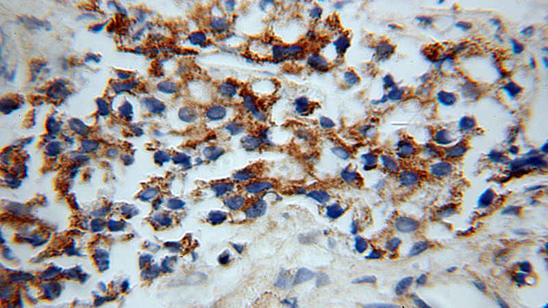 Immunohistochemical of paraffin-embedded human gliomas using Catalog No:113413(OPRL1 antibody) at dilution of 1:100 (under 40x lens)
