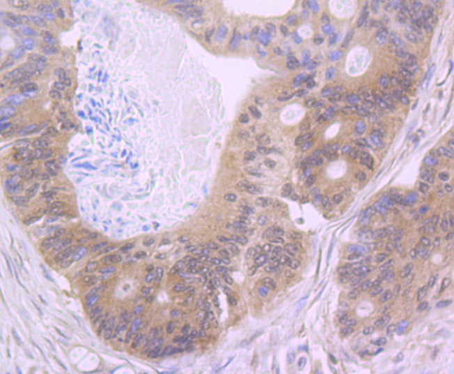 Fig5: Immunohistochemical analysis of paraffin-embedded human colon cancer tissue using anti-NLRC3 antibody. Counter stained with hematoxylin.