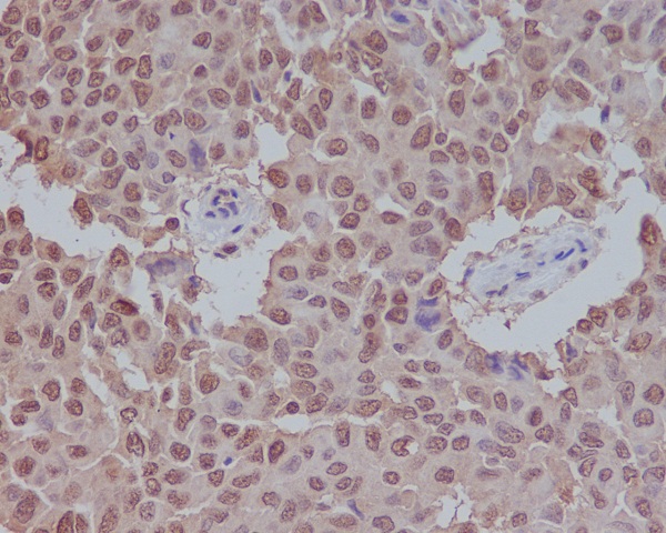 Immunohistochemical analysis of paraffin-embedded human breast carcinoma, using Sumo 1 Antibody .