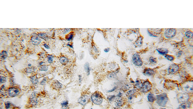 Immunohistochemical of paraffin-embedded human lung cancer using Catalog No:108899(CBLB antibody) at dilution of 1:100 (under 10x lens)