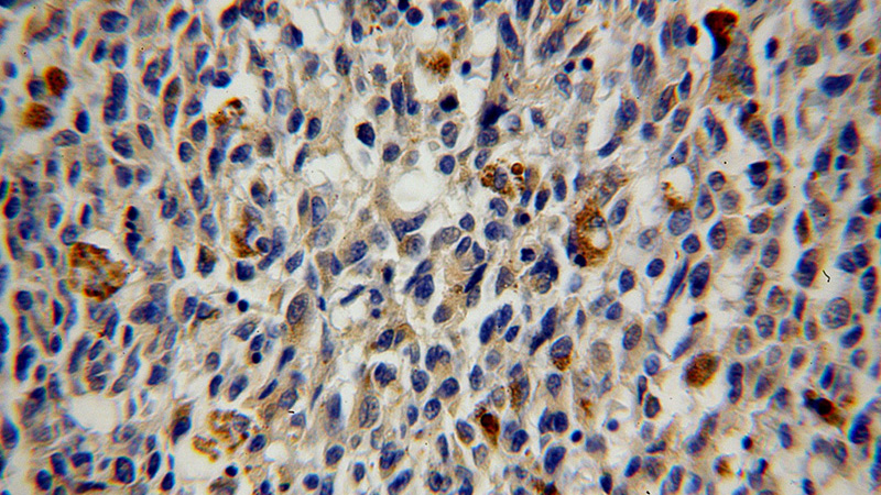 Immunohistochemical of paraffin-embedded human malignant melanoma using Catalog No:110835(GALE antibody) at dilution of 1:100 (under 40x lens)