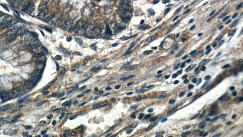 Immunohistochemistry of paraffin-embedded human colon slide using Catalog No:109976(DocK1 Antibody) at dilution of 1:50