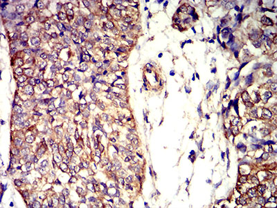 Fig5: Immunohistochemical analysis of paraffin-embedded bladder cancer tissues using anti-APC2 antibody. The section was pre-treated using heat mediated antigen retrieval with Tris-EDTA buffer (pH 8.0) for 20 minutes. The tissues were blocked in 5% BSA for 30 minutes at room temperature, washed with ddH2O and PBS, and then probed with the primary antibody ( 1/100) for 30 minutes at room temperature. The detection was performed using an HRP conjugated compact polymer system. DAB was used as the chromogen. Tissues were counterstained with hematoxylin and mounted with DPX.