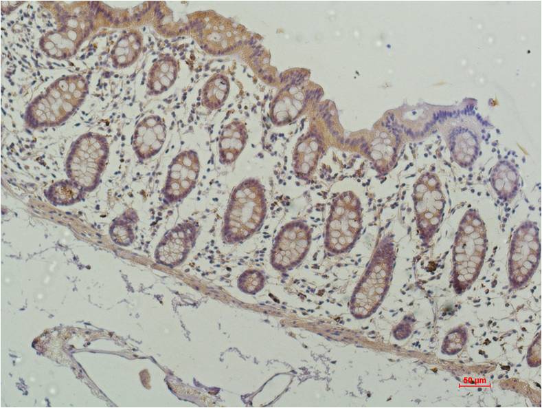 Immunohistochemical analysis of paraffin-embedded Human Colon Carcinoma Tissue usingHADC1 Mouse mAb diluted at 1:200.