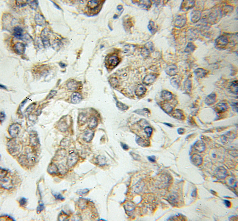 Immunohistochemical of paraffin-embedded human pancreas cancer using Catalog No:115096(SCG3 antibody) at dilution of 1:50 (under 10x lens)