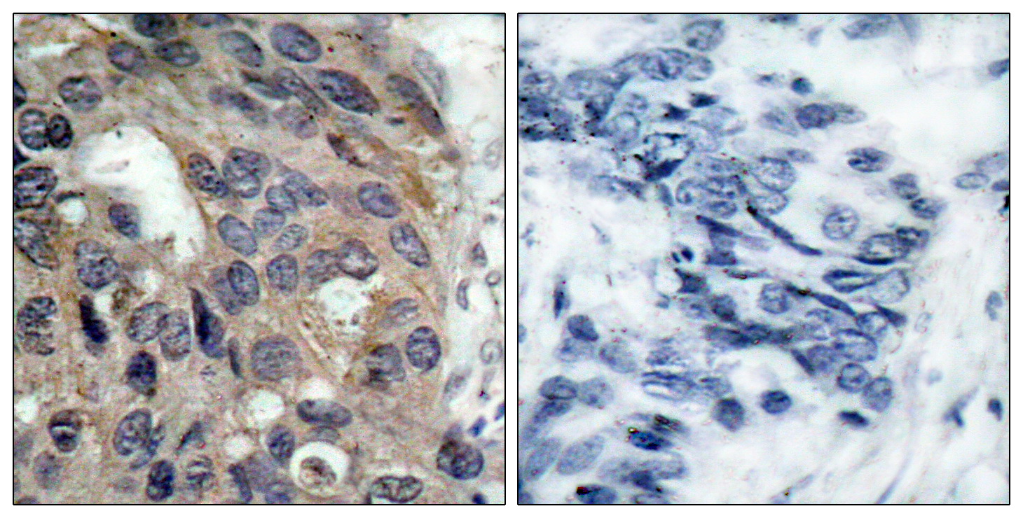 Immunohistochemical analysis of paraffin-embedded human breast carcinoma tissue using Src (Phospho-Tyr529) Antibody (left) or the same antibody preincubated with blocking peptide (right).