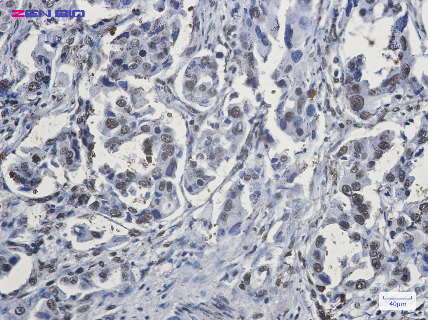 Immunohistochemistry of hnRNP G in paraffin-embedded Human lung cancer tissue using hnRNP G Rabbit pAb at dilution 1/20