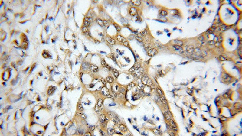 Immunohistochemical of paraffin-embedded human colon cancer using Catalog No:112679(MAP3K11 antibody) at dilution of 1:50 (under 10x lens)