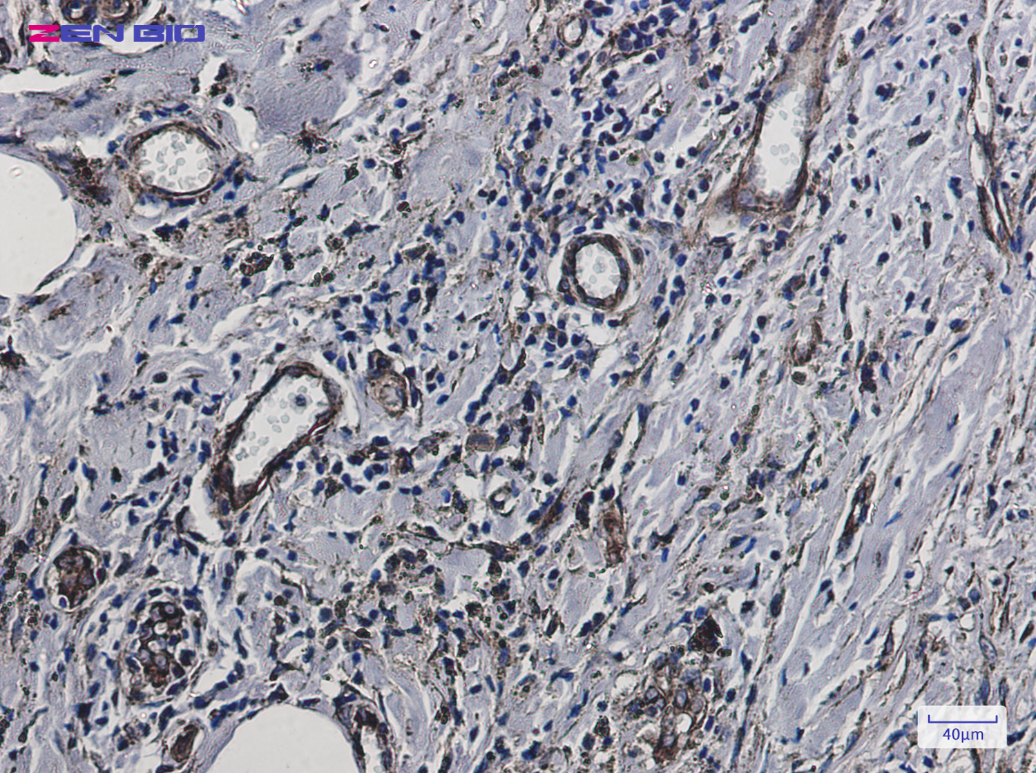 Immunohistochemistry of Fragilis in paraffin-embedded Human breast cancer tissue using Fragilis Rabbit pAb at dilution 1/50