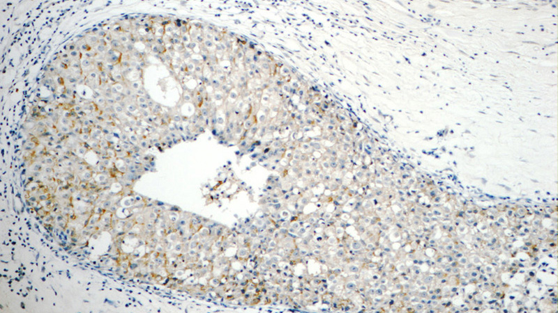 Immunohistochemistry of paraffin-embedded human breast cancer tissue slide using Catalog No:114502(RABL3 Antibody) at dilution of 1:50 (under 10x lens)